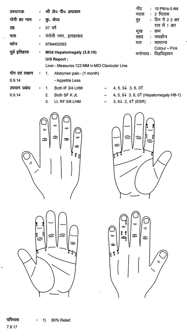 Hepatomegaly